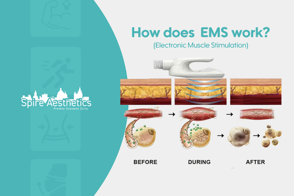 EMS treatment for post pregnancy weight loss treatment Southampton