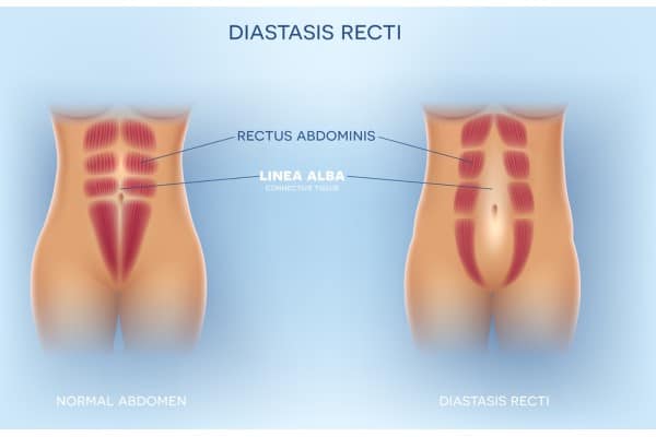 What Non-Surgical Options Are Available for Diastasis Recti Southampton?