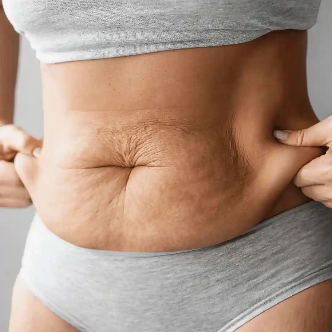 Is It Normal to Have Loose Skin After Pregnancy Southampton?