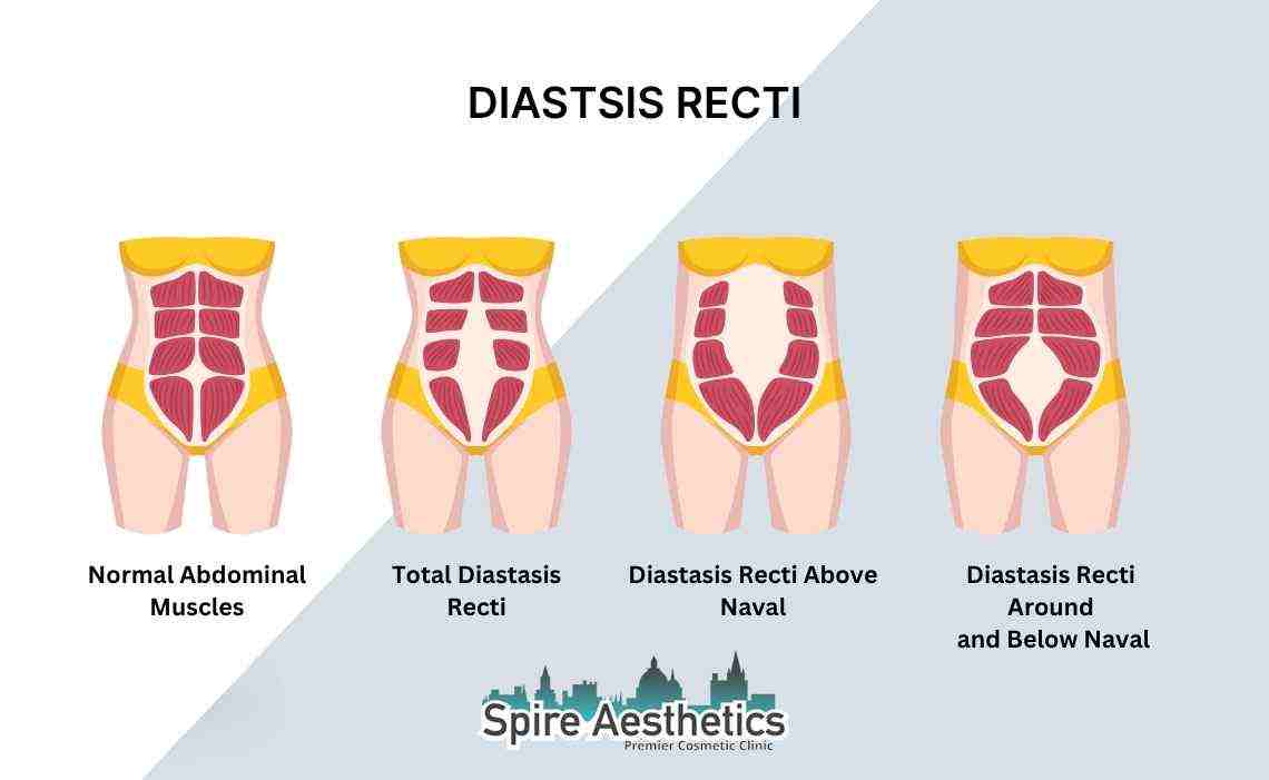 Is Non-Surgical Diastasis Recti Treatment Right for You? Common Concerns Answered Southampton